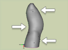 Corset de fracture